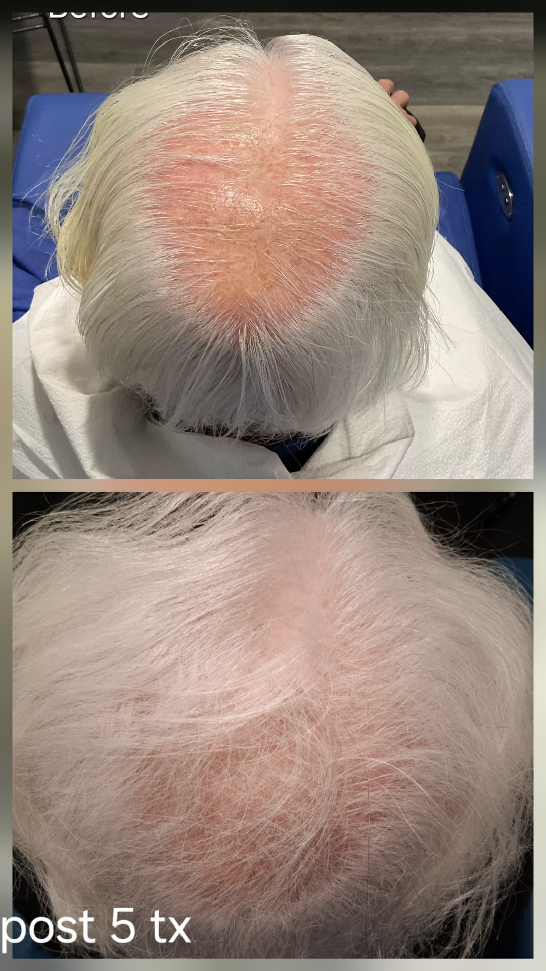 Hair restoration result